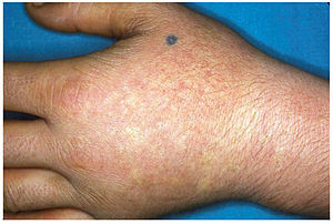 EPP Causes Extreme Sensitivity to Sunlight Among Other Problems
